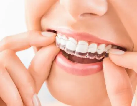 Invisalign Aligner Process & Daily Life in Altrincham