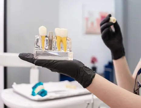 Why Dental Implants Are the Best Choice for Replacing Missing Teeth