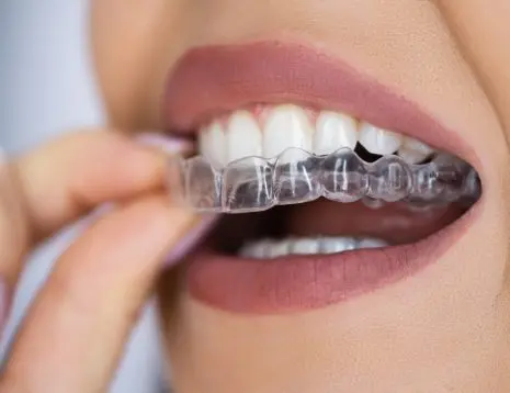 Straighten Your Teeth Comfortably with Invisalign Aligners