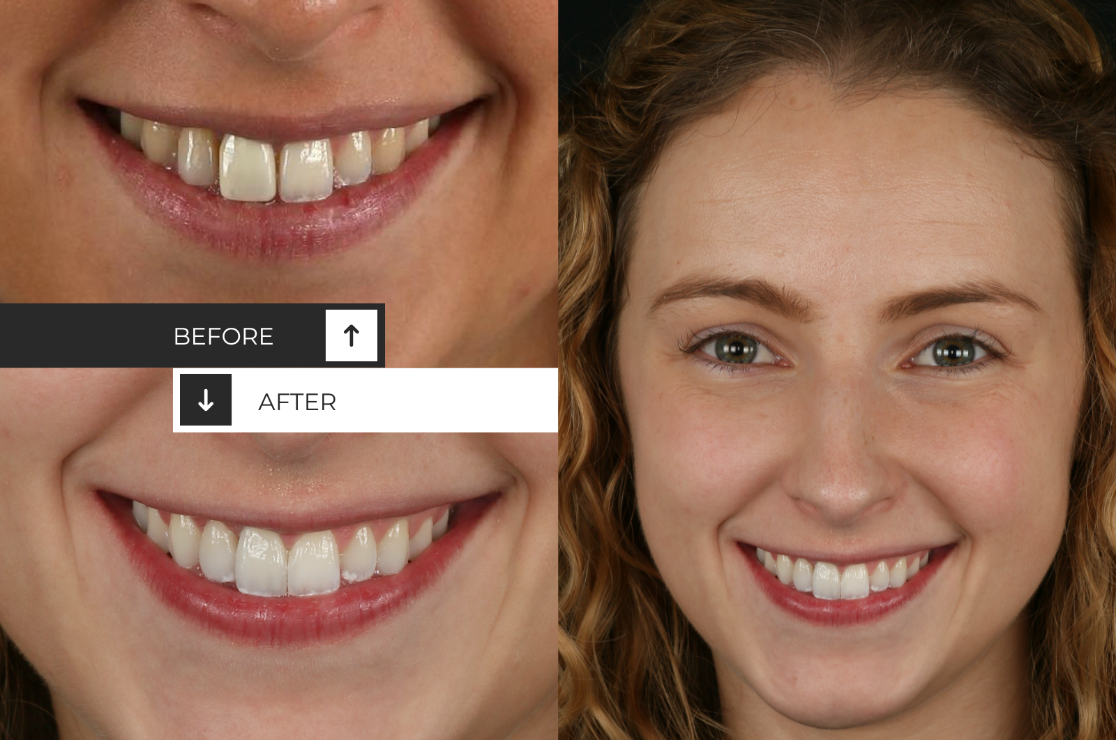 Wedding Smile, Invisalign