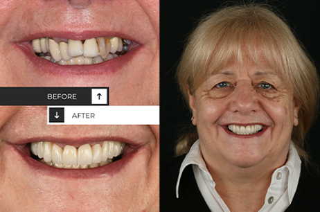 Dental Implants, Orthodontics and Veneers