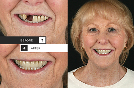 Dental Implants & Veneers