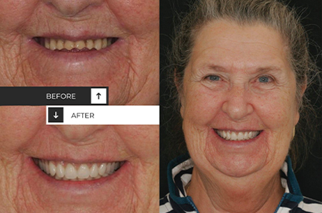 Veneers & Dental Implants