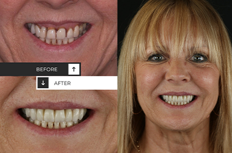 Cosmetic Veneers