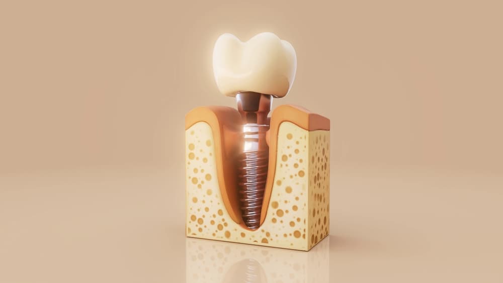 Dental Implants in Altrincham